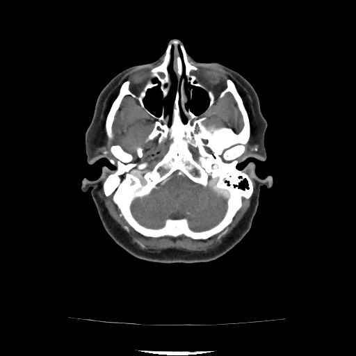 Acute subarachnoid hemorrhage and accessory anterior cerebral artery (Radiopaedia 69231-79009 Axial C+ arterial phase 79).jpg