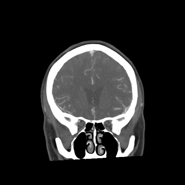 Acute subarachnoid hemorrhage and accessory anterior cerebral artery (Radiopaedia 69231-79009 Coronal C+ arterial phase 28).jpg