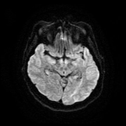 File:Acute superior cerebellar artery territory infarct (Radiopaedia 84104-99358 Axial DWI 19).jpg