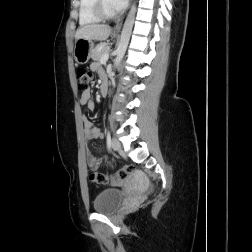 Acute uncomplicated appendicitis (Radiopaedia 73704-84499 Sagittal C+ portal venous phase 123).jpg