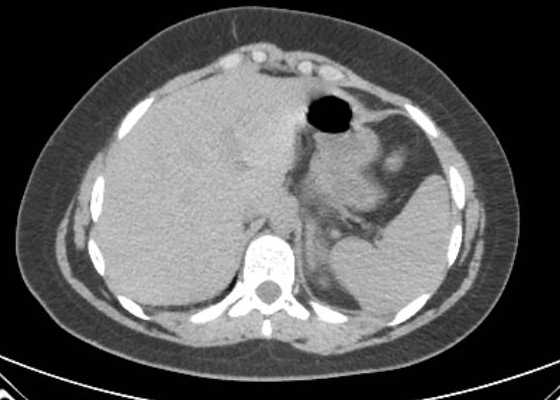 Acute unilateral nonhemorrhagic adrenal infarction (Radiopaedia 67560-76957 Axial non-contrast 14).jpg