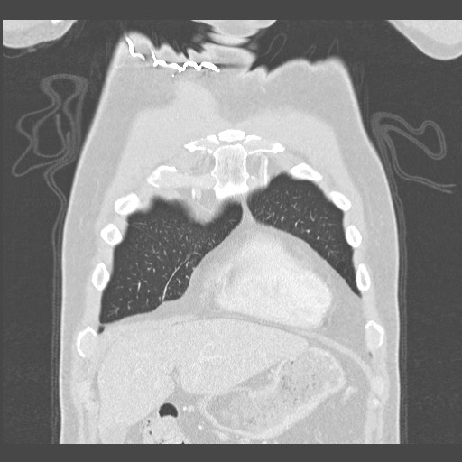 Adenocarcinoma of the lung (Radiopaedia 59871-67325 Coronal lung window 4).jpg