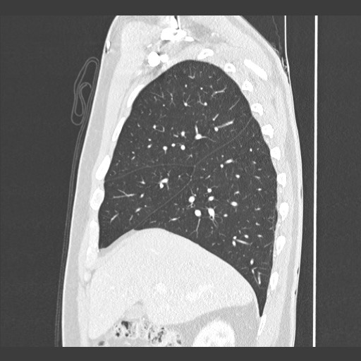 Adenocarcinoma of the lung (Radiopaedia 59871-67325 Sagittal lung window 25).jpg
