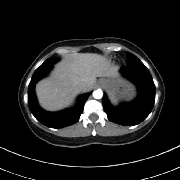 Adenocystic carcinoma of the trachea (Radiopaedia 47677-52525 Axial C+ arterial phase 72).jpg
