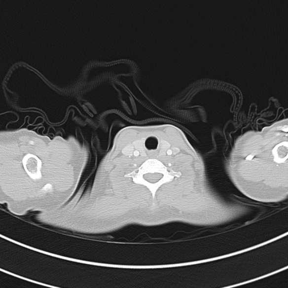 Adenocystic carcinoma of the trachea (Radiopaedia 47677-52525 Axial lung window 24).jpg