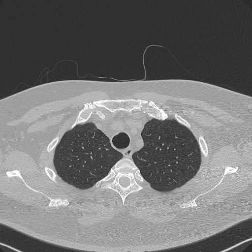 File:Adenoid cystic carcinoma of the trachea (Radiopaedia 49042-54137 Axial lung window 63).jpg