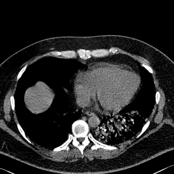 Adenoid cystic carcinoma of the trachea (Radiopaedia 49042-54137 Axial non-contrast 248).jpg