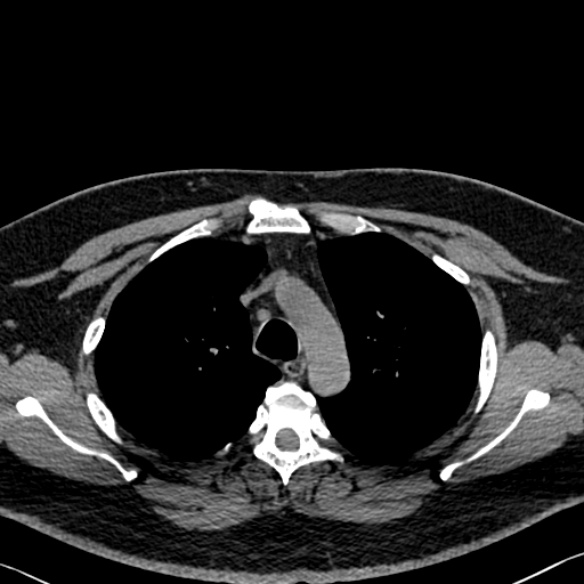 File:Adenoid cystic carcinoma of the trachea (Radiopaedia 49042-54137 Axial non-contrast 93).jpg