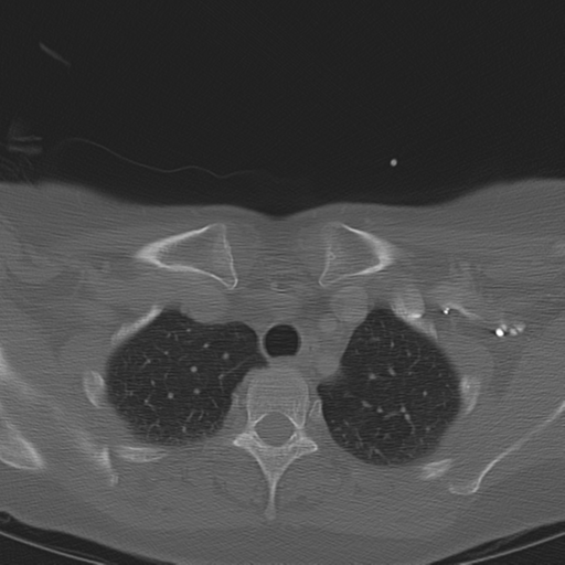 Adenoid cystic tumor of palate (Radiopaedia 46980-51518 Axial bone window 73).png