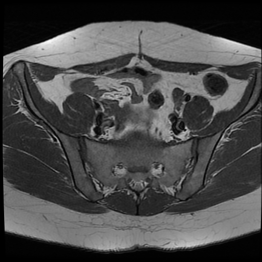 File:Adenomyosis-scar endometriosis (Radiopaedia 65863-75022 Axial T1 8).jpg