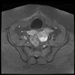 File:Adenomyosis within a didelphys uterus (Radiopaedia 70175-80215 Axial T1 C+ fat sat 21).jpg