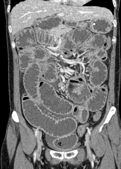 Adhesional small bowel obstruction (Radiopaedia 48397-53305 Coronal C+ portal venous phase 132).jpg