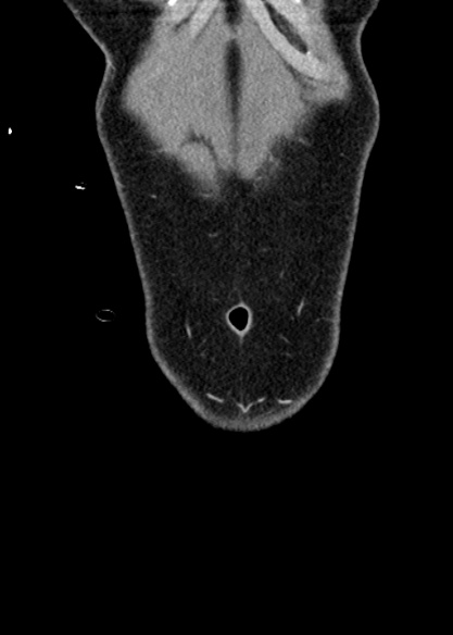 Adhesional small bowel obstruction (Radiopaedia 48397-53305 Coronal C+ portal venous phase 25).jpg