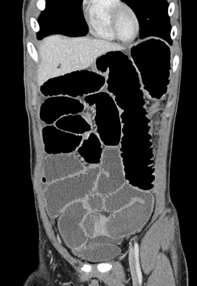 Adhesional small bowel obstruction (Radiopaedia 52107-57980 Coronal C+ portal venous phase 18).jpg
