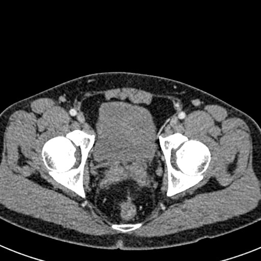 Adhesional small bowel obstruction (Radiopaedia 58900-66131 Axial C+ portal venous phase 50).jpg