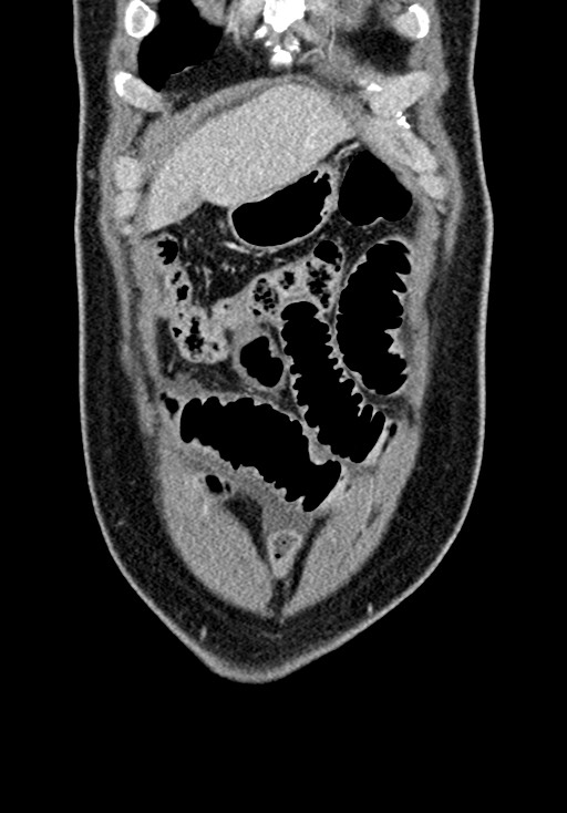 Adhesional small bowel obstruction (Radiopaedia 58900-66131 Coronal C+ portal venous phase 72).jpg