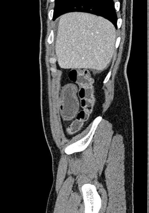 Adhesional small bowel obstruction (Radiopaedia 58900-66131 Sagittal C+ portal venous phase 38).jpg