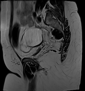 File:Adnexal multilocular cyst (O-RADS US 3- O-RADS MRI 3) (Radiopaedia 87426-103754 Sagittal T2 19).jpg