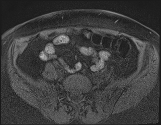File:Adnexal multilocular cyst (O-RADS US 3. O-RADS MRI 3) (Radiopaedia 87426-103754 Axial 221).jpeg