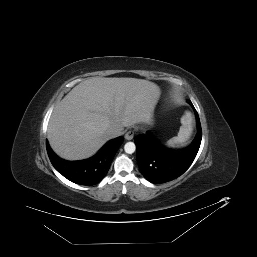 Adrenal angiosarcoma (Radiopaedia 81081-94671 Axial C+ arterial phase 10).jpg