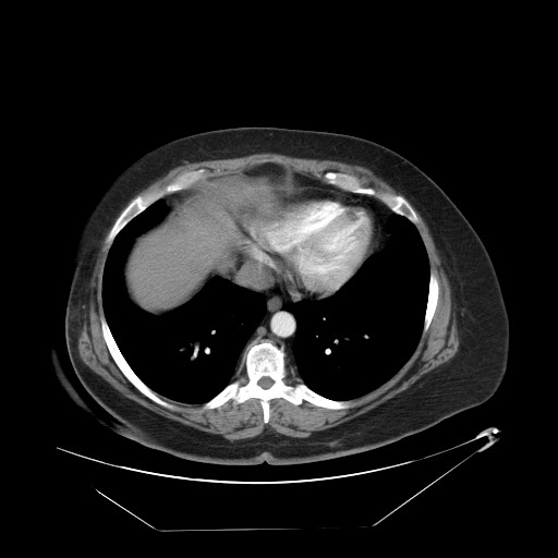Adrenal angiosarcoma (Radiopaedia 81081-94671 Axial C+ arterial phase 5).jpg