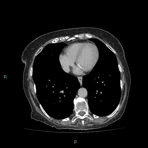 File:Adrenal collision tumor (ACT) (Radiopaedia 48462-53379 Axial C+ delayed 2).jpg