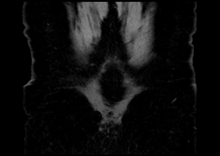 Adrenal cortical carcinoma (Radiopaedia 64017-72769 Coronal C+ portal venous phase 54).jpg