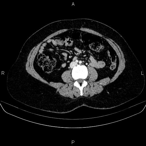 Adrenal cortical carcinoma (Radiopaedia 84882-100379 Axial C+ portal venous phase 51).jpg