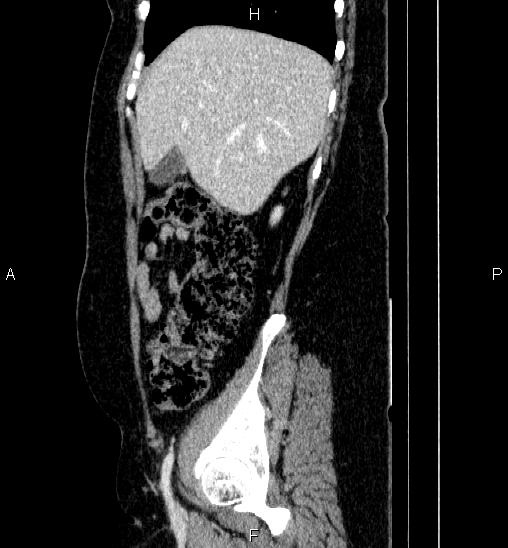 Adrenal cortical carcinoma (Radiopaedia 84882-100379 Sagittal C+ portal venous phase 19).jpg