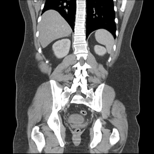 Adrenal cyst (Radiopaedia 45625-49776 Coronal C+ portal venous phase 52).png