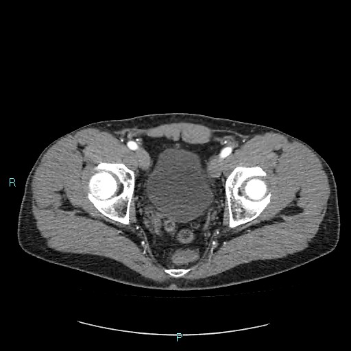 File:Adrenal cystic lymphangioma (Radiopaedia 83161-97534 Axial C+ arterial phase 90).jpg