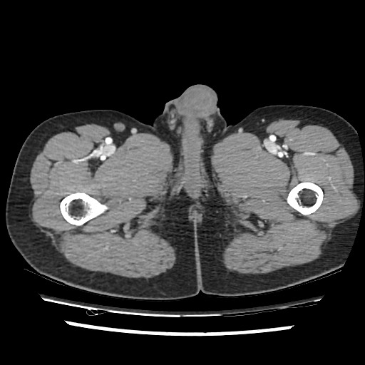 Adrenal gland trauma (Radiopaedia 81351-95078 Axial Dual bolus trauma C+ 131).jpg