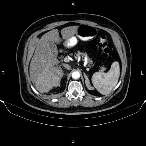 Adrenal hemorrhage (Radiopaedia 62622-70916 Axial C+ arterial phase 113).jpg