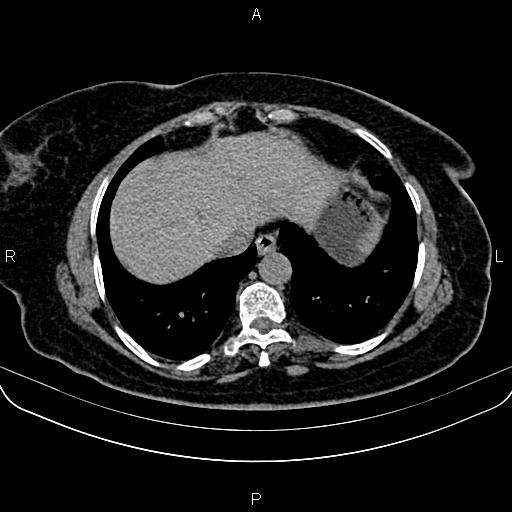 Adrenal myelolipoma (Radiopaedia 82742-96986 Axial non-contrast 9).jpg