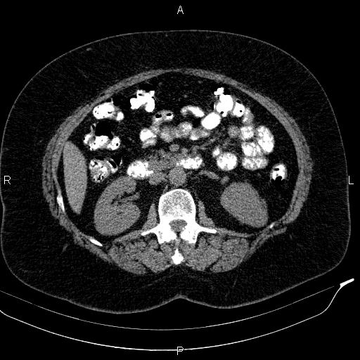 Adrenal myelolipoma (Radiopaedia 84319-99617 Axial With oral contrast 96).jpg