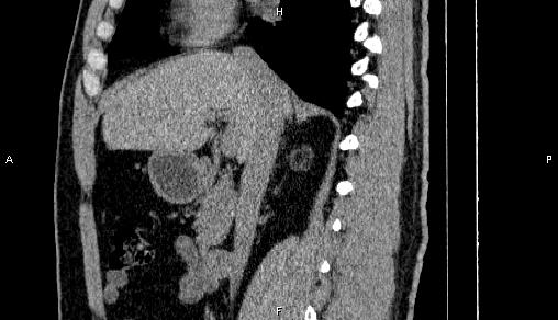 Adrenal myelolipoma (Radiopaedia 84321-99619 Sagittal non-contrast 45).jpg