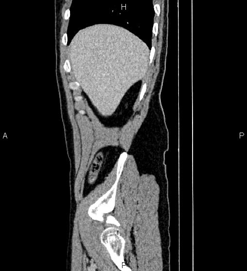 Adrenal myelolipoma (Radiopaedia 87794-104246 Sagittal renal cortical phase 12).jpg