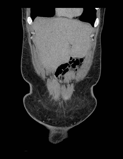 Adrenal myelolipoma - bilateral (Radiopaedia 74805-85810 Coronal C+ portal venous phase 226).jpg
