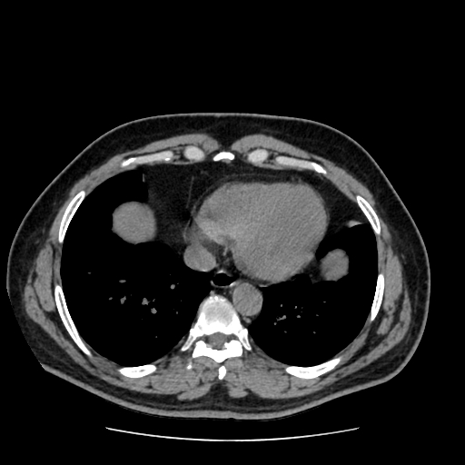 Adrenal myelolipoma and beaver tail liver (Radiopaedia 86201-102193 Axial non-contrast 9).jpg