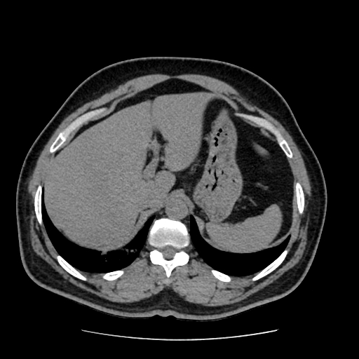 Adrenal myelolipoma and beaver tail liver (Radiopaedia 86201-102193 Axial non-contrast 90).jpg