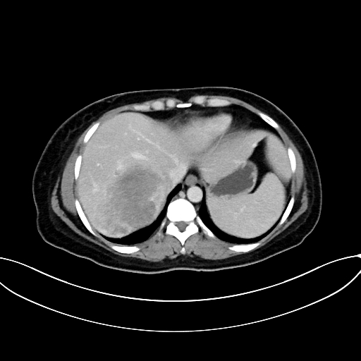 Adrenocortical carcinoma (Radiopaedia 87281-103569 Axial C+ portal venous phase 15).jpg