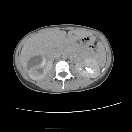 Adult polycystic kidney disease (Radiopaedia 48845-53876 Axial renal excretory phase 37).jpg