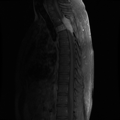 File:Aggressive vertebral hemangioma (Radiopaedia 39937-42404 B 12).png