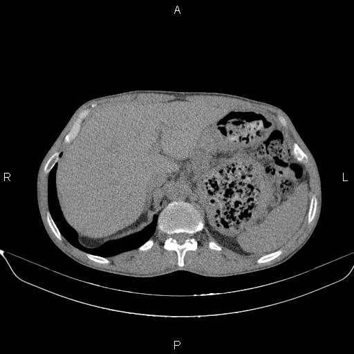 Air bronchogram in pneumonia (Radiopaedia 85719-101512 Axial non-contrast 67).jpg