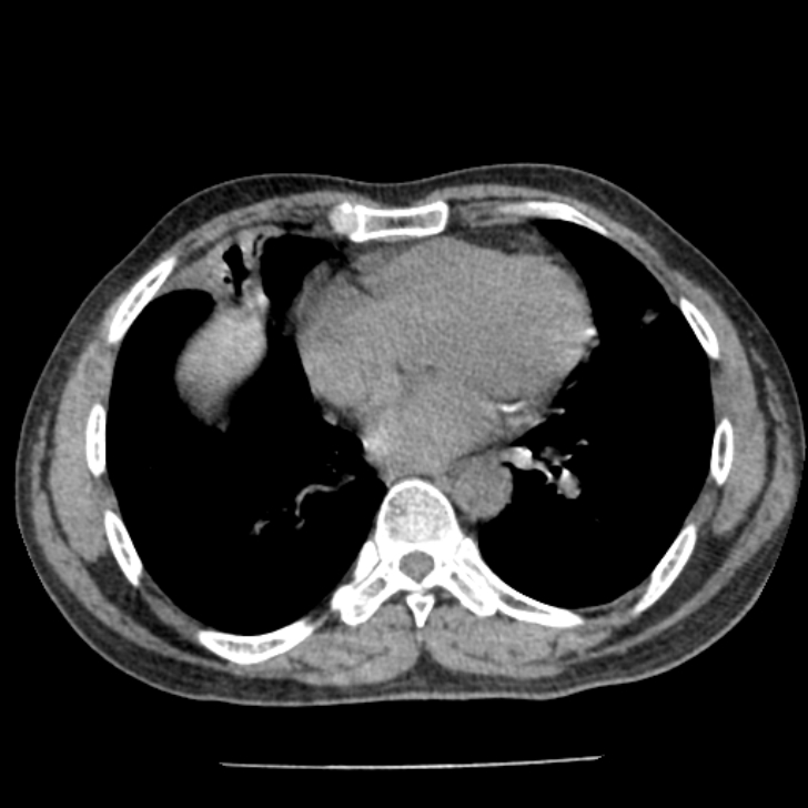 Airway foreign body in adult (Radiopaedia 85907-101779 Axial liver window 121).jpg