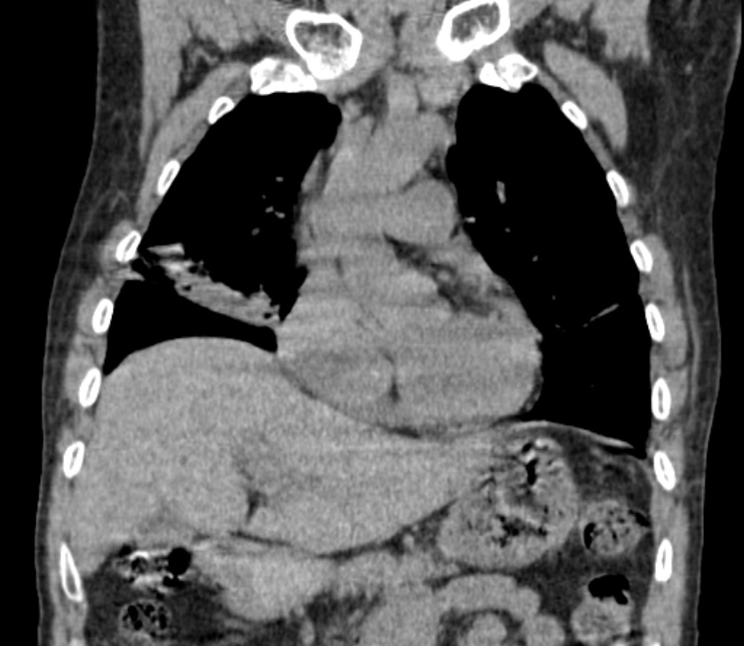 Airway foreign body in adult (Radiopaedia 85907-101779 Coronal liver window 95).jpg