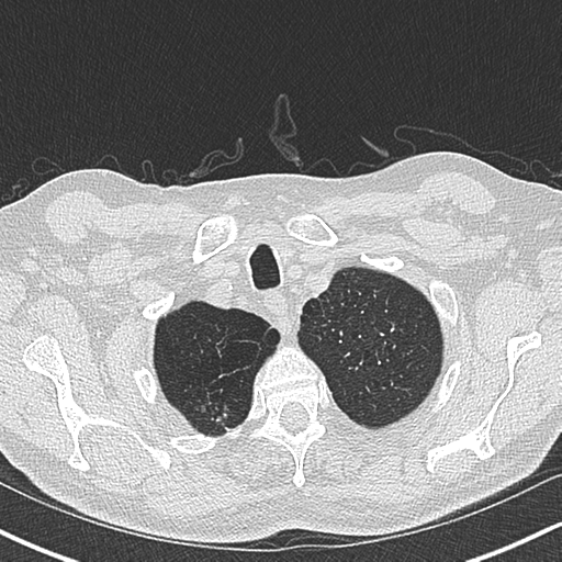 Allergic bronchopulmonary aspergillosis (Radiopaedia 44760-48571 Axial lung window 8).png