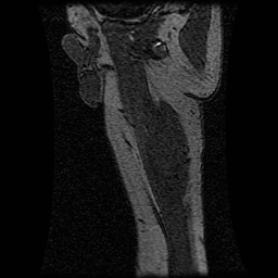 Alveolar soft part sarcoma (Radiopaedia 64501-73678 D 23).jpg