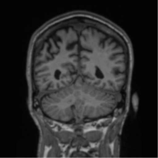 File:Alzheimer's disease- with apraxia (Radiopaedia 54763-61011 Coronal T1 31).png