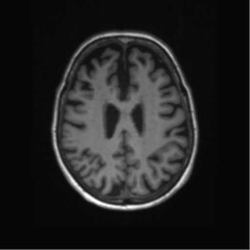 File:Alzheimer's disease (Radiopaedia 42658-45802 Axial T1 55).png